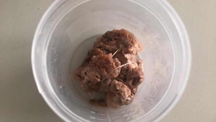 Çanakkaleli hastanın yemek borusundan 6 santimlik et parçası çıktı